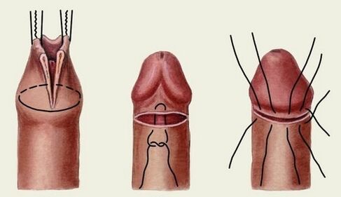 die Essenz der Penisvergrößerungschirurgie